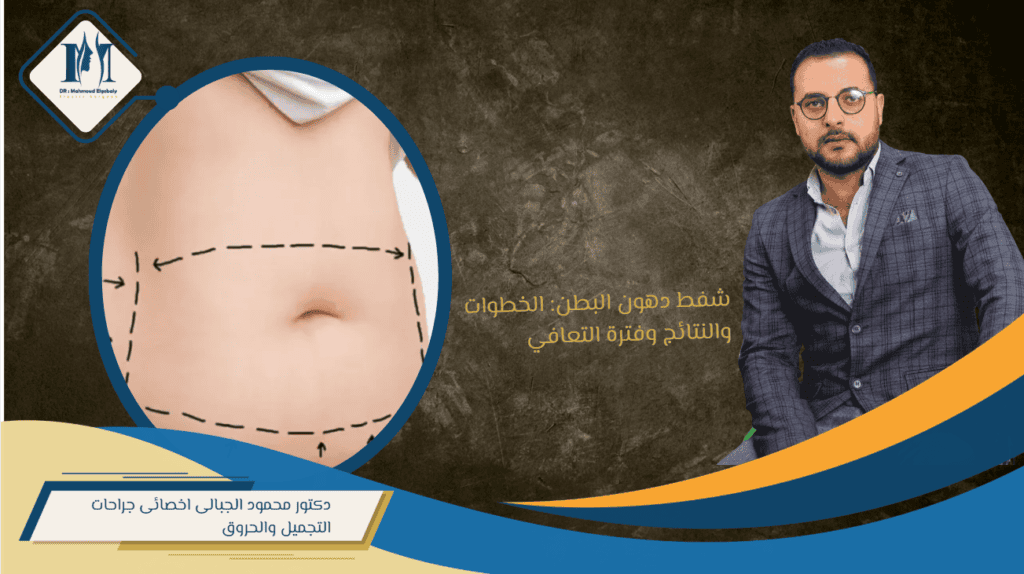 شفط دهون البطن