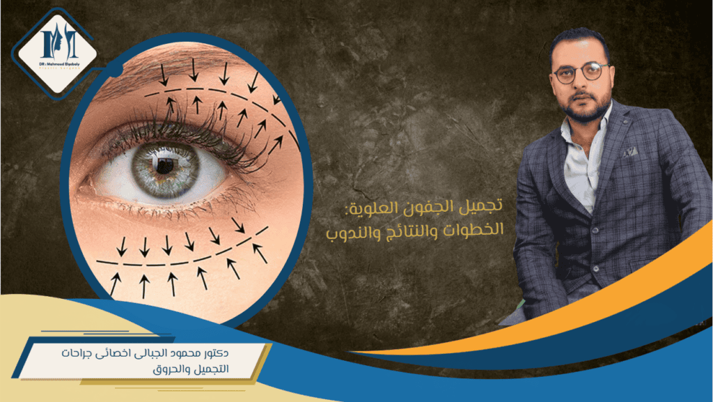 تجميل الجفن العلوي