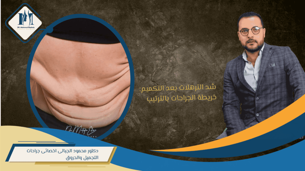 شد الترهلات
