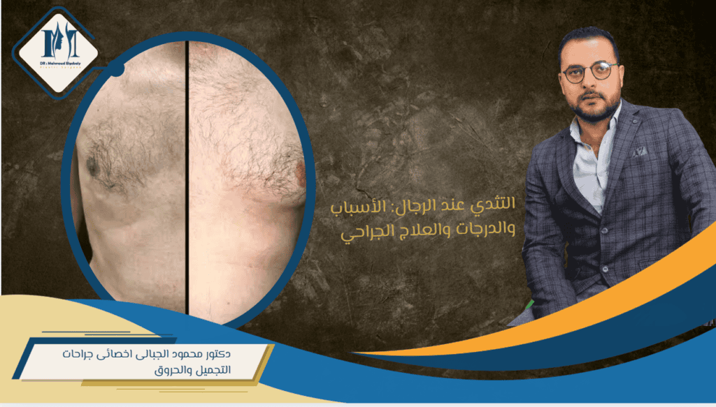 التثدي عند الرجال